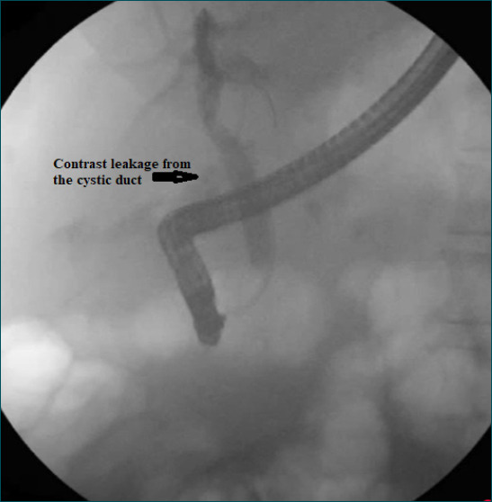 Endoscopic management of cystic stump leaks: Insights from a tertiary care center.