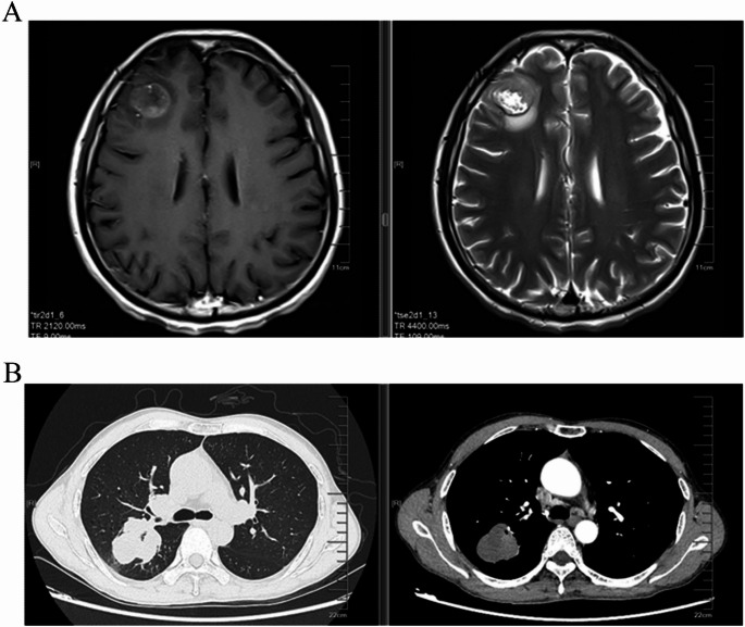 Long-term survival of a SMARCA4-deficient undifferentiated thoracic tumor with brain metastasis successfully treated with multimodal treatment: a case report and literature review.
