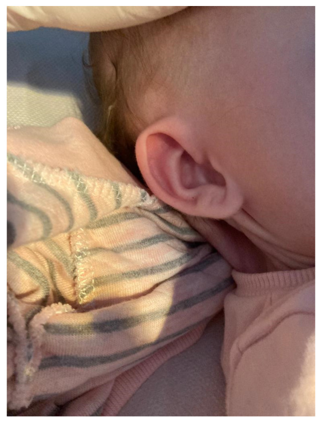 A Case Report of Tissue Mosaicism in 45,X0/46,XY: Diagnostic Complexity in a Newborn with Ambiguous Genitalia.