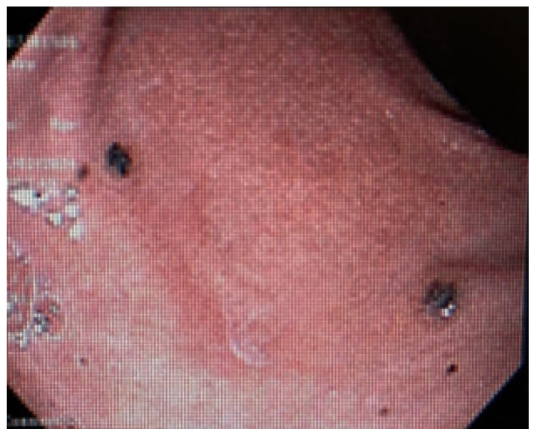 Disseminated Melanoma with Extensive Gastrointestinal Tract Involvement: Incidental Detection of Metastases on Upper Endoscopy.