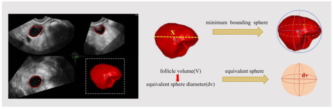 Follicular sphericity based on three-dimensional transvaginal ultrasound algorithms predicts ovarian responsiveness to in vitro fertilization.