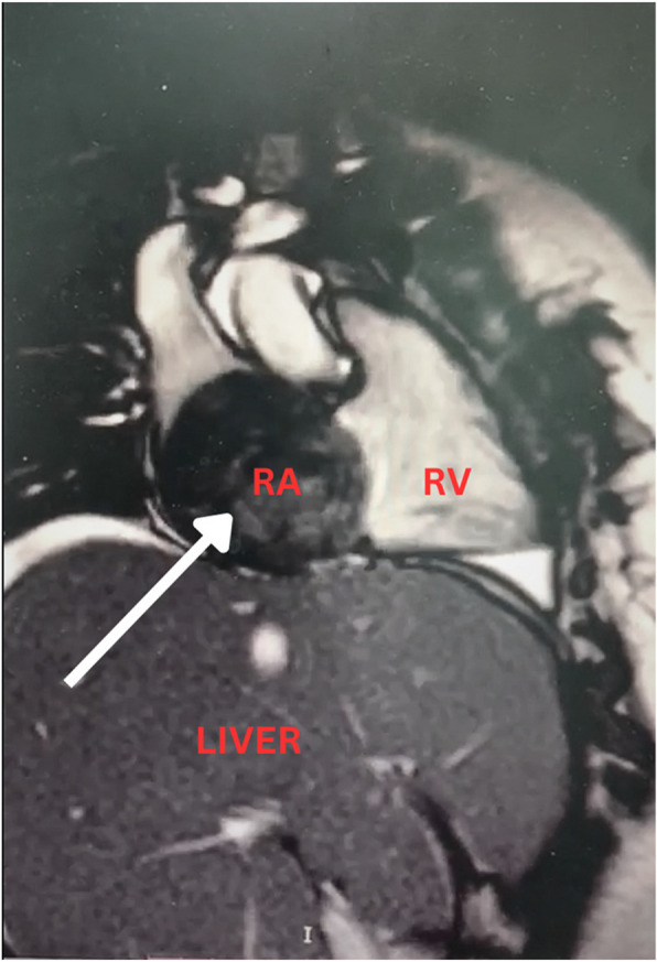 Giant right atrial myxoma emerging from the suprahepatic inferior vena cava, extending to the right atrium; a case report and literature review.