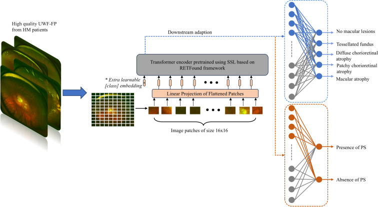 Foundation models in ophthalmology: a preliminary study on AI-assisted diagnosis of myopic maculopathy and posterior staphyloma using ultra-widefield fundus images.