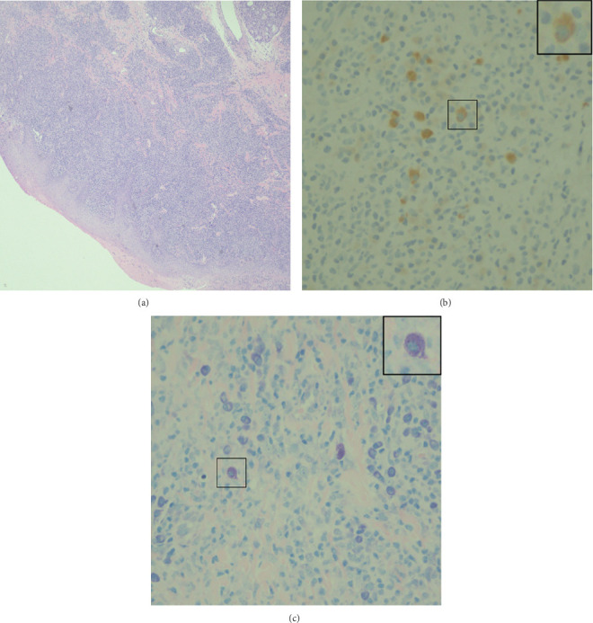 Mucocutaneous Leishmaniasis With Oral Involvement: A Case Report.