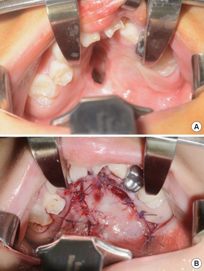 Familial predisposition to flap necrosis after palatoplasty: a case report of two siblings with bilateral cleft palate.