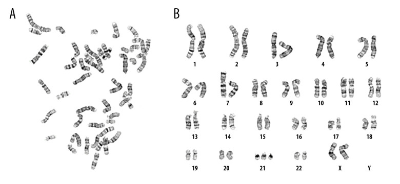 Comprehensive Cytogenetic Analysis Reveals Mosaicism in Newborn with Negative Prenatal Down Syndrome Screening: A Case Report.