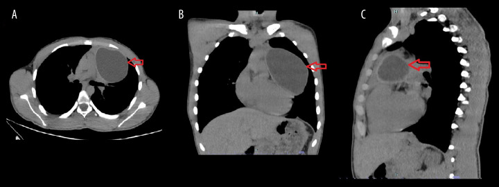 Thoracoscopic Approach for Treating a Primary Hydatid Cyst in the Thymus in a Teenager: A Case Report.