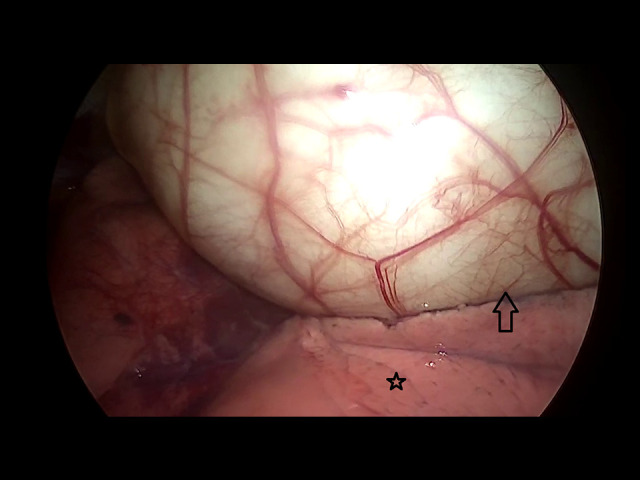 Thoracoscopic Approach for Treating a Primary Hydatid Cyst in the Thymus in a Teenager: A Case Report.