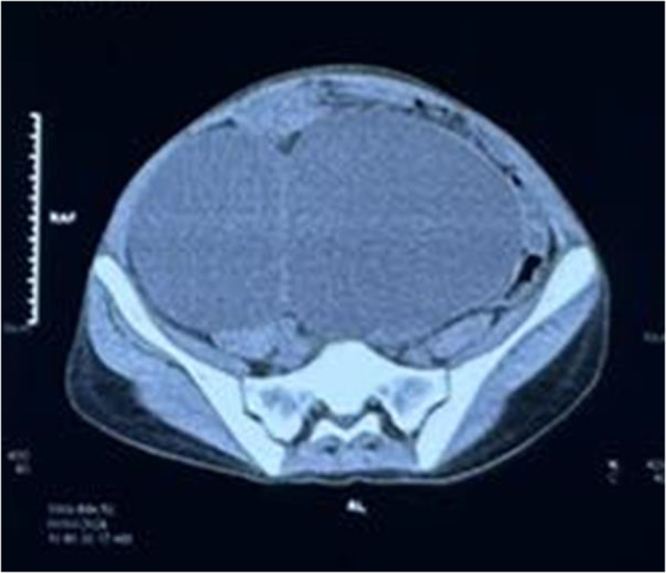 A rare case of advanced CKD with extensive cystic renal disease causing bowel obstruction.
