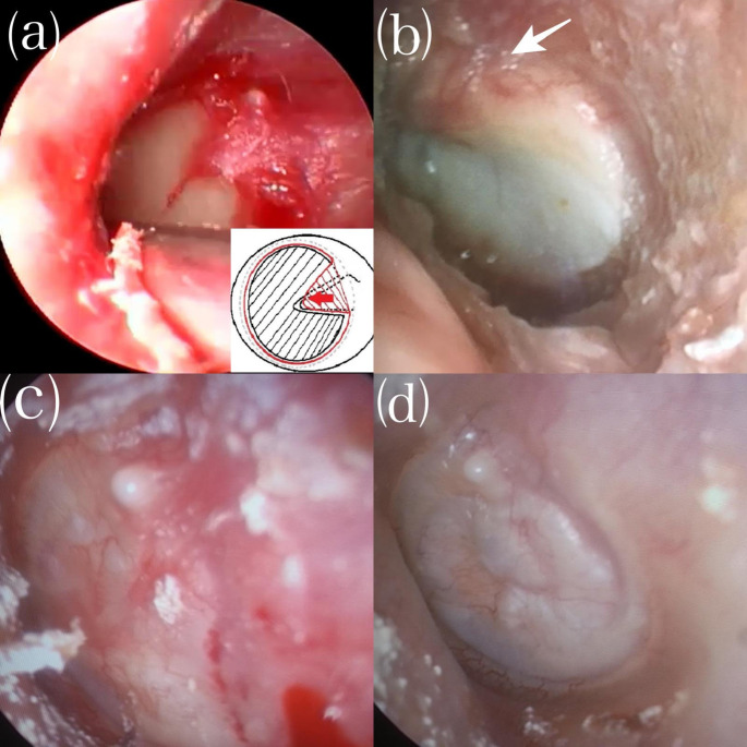 Preliminary results of a new endoscopic underlay cartilage tympanoplasty with lateral malleolar flap.