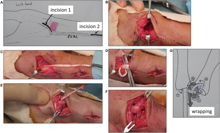 Trapeziectomy and Ligament Reconstruction Using a Reinforced Half-Slip of the Extensor Carpi Radialis Longus Tendon for Thumb Carpometacarpal Osteoarthritis.