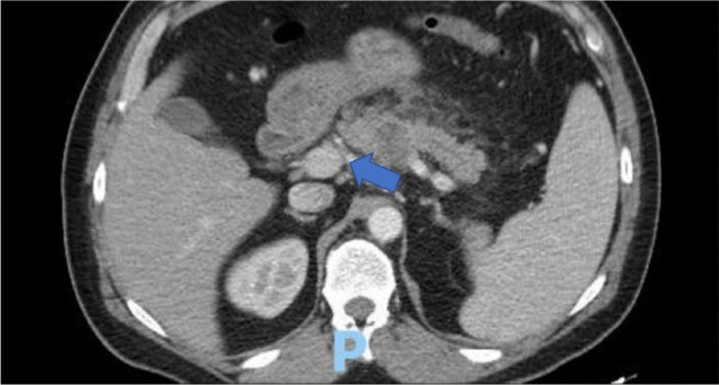 Rapid Metastatic Growth of A Pancreatic Signet Ring Cell Carcinoma within 6 weeks of A Negative CT.