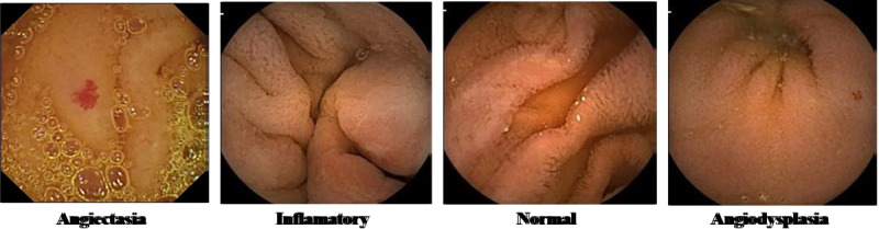 Utilizing Deep Convolutional Neural Networks and Hybrid Classification for Gastrointestinal Disease Diagnosis from Capsule Endoscopy Images.