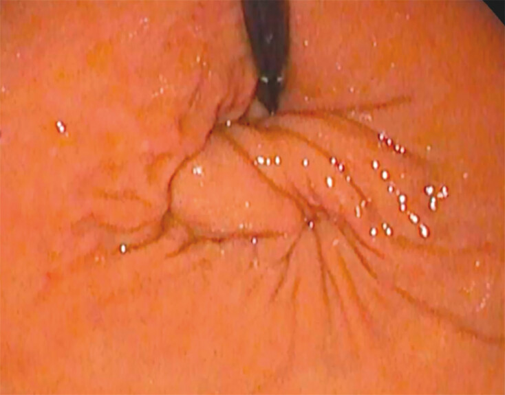 Safety and efficacy of peroral endoscopic myotomy with endoscopic fundoplication compared with POEM alone: International multicenter cohort study.