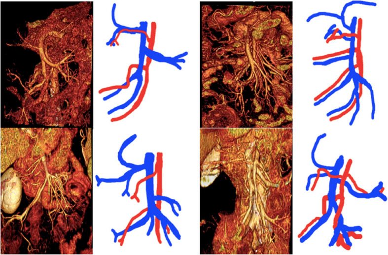 Three-dimensional (3D) vascular reconstruction of the superior mesenteric vessels: a practical tool for the young surgeon approaching right hemicolectomy with CME technique.