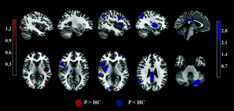 Neurofunctional representations of instrumental learning in psychosis: a meta-analysis of neuroimaging studies.