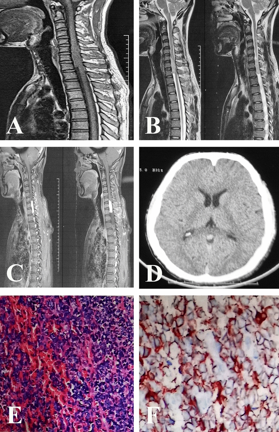 Intraventricular metastasis with malignant progression of an intraspinal solitary fibrous tumor: a case report and review of the literature.