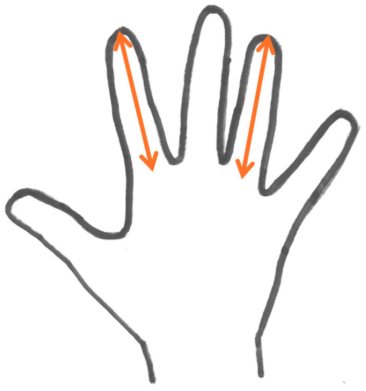 Handgrip Strength Asymmetry in Female Basketball Players: The Critical Role of Arm Position and the Challenge of Statistical Power.