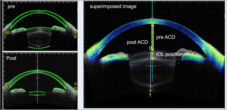 Intraocular Lens Position Stability During Phacovitrectomy with Air or Gas Tamponade.