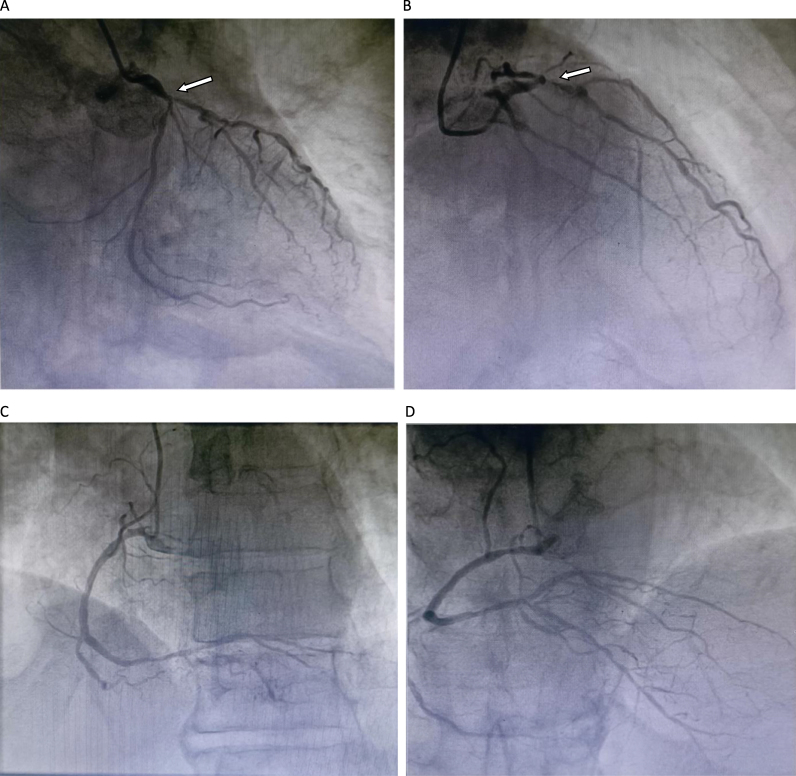 A comorbidity of cardiac atherosclerotic disease with cardiac myxomas being concomitantly treated by coronary artery bypass grafting coupling with tumor resection: a case report.