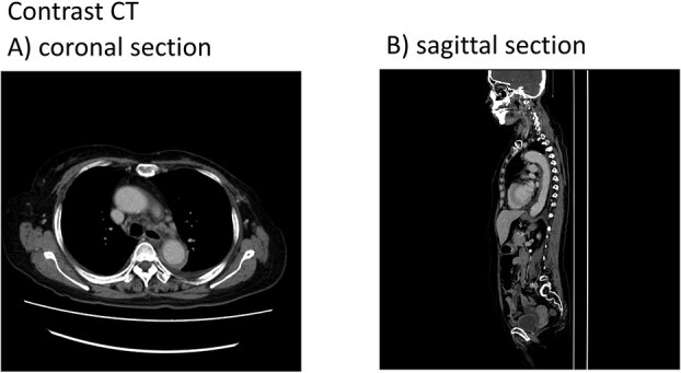 G-CSF-induced Aortitis in an elderly woman successfully managed with prednisolone: a case report and literature review.