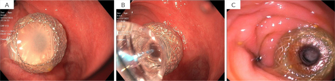 Endoscopic Ultrasound-Guided Drainage of Extraluminal Colorectal Mucocele Using A Lumen-Apposing Metal Stent: A Novel Approach.