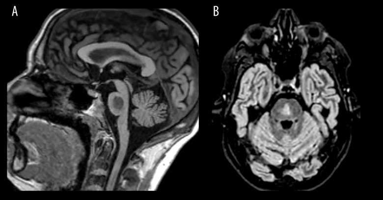 Central Pontine Myelinolysis in a Patient with Alcohol Use Disorder without Hyponatremia: A Case Report.