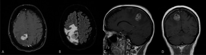 High-grade glioma with pleomorphic and pseudopapillary features: a single-institution series of three cases.