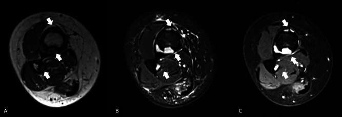 Osteofibrous Dysplasia Involving Both Tibia and Fibula: A Rare Campanacci‑Type Presentation.