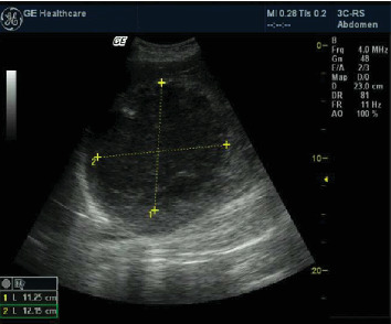 Management of a Pregnant Woman With Malaria, Stillbirth, and a 12 × 11-cm Amoebic Liver Abscess in a Burundian Hospital: A Case Report.