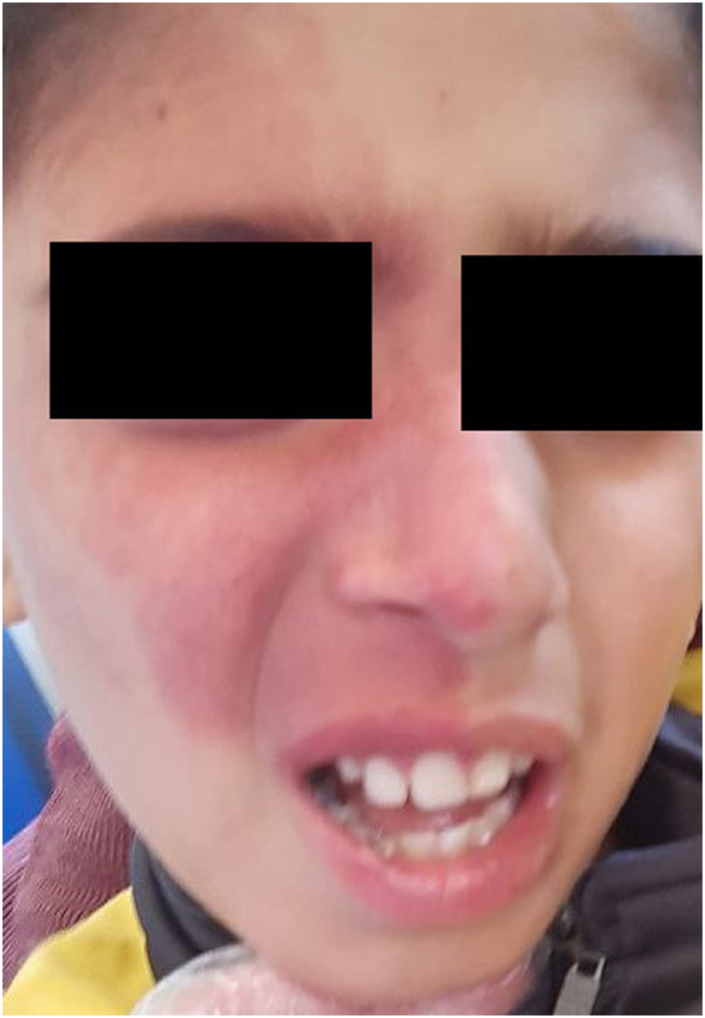 Sturge-Weber syndrome Type I: a rare case report.