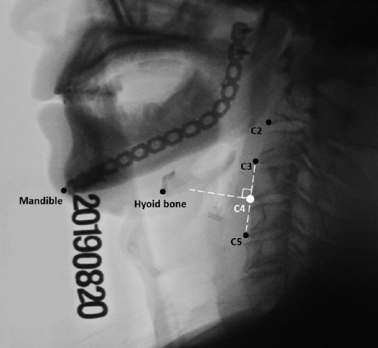Temporal and Kinematic Measurements of Hyoid Bone Excursion in Patients With Head and Neck Cancer.
