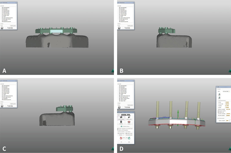 Fit analysis of implant-supported Co-Cr bars fabricated using casting, selective laser sintering, soft and dense milling techniques.