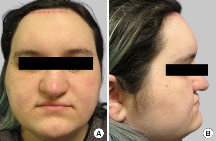 Pott puffy tumor following upper facial feminization surgery: a case report and literature review.