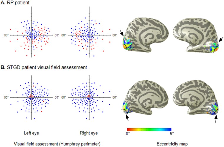 Cortical response to transient and long-term visual field loss.
