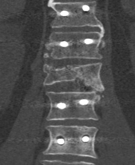 Factors that influence long term instrumentation stability in patients with unstable thoracolumbar injuries.