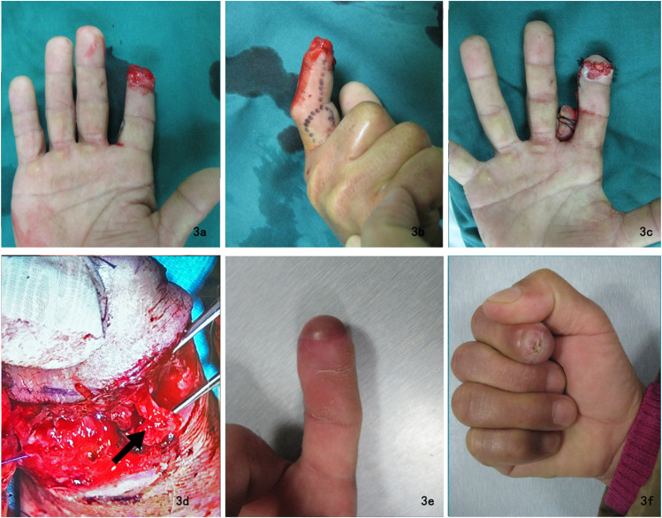 Similar Diameter of Cutaneous Branches of the Proper Digital Nerve and Stump of the Proper Palmar Digital Nerve was a Key Factor for the Sensory Reconstruction in Short Term Outcome of Finger Pulp Defects: A Retrospective Study.