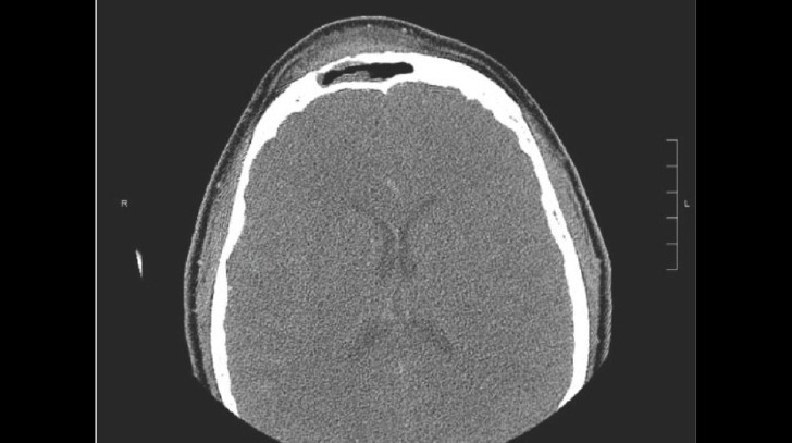 Pott puffy tumor following upper facial feminization surgery: a case report and literature review.