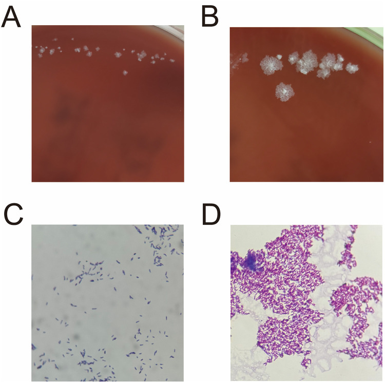 A Case Report of Refractory <i>Mycobacterium wolinskyi</i> Knee Infection in a Metabolic Syndrome Patient: mNGS Diagnosis and Pharmacist-Guided Therapy.