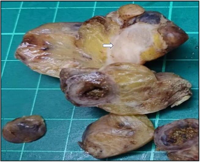 Primary signet ring cell carcinoma of the appendix presenting as gangrenous appendicitis with peritonitis: a case report.