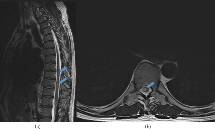 Paradoxical Reactions of Central Nervous System Tuberculosis: Report of Three Immunocompetent Cases.