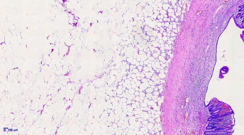 Submucosal Cecal Lipoma Mimicking Malignancy in a 51-Year-Old Man: A Diagnostic Challenge in Routine Colonoscopy.