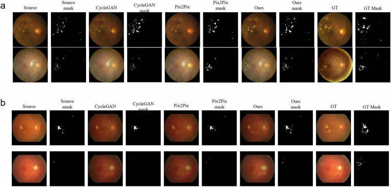 Forecasting the diabetic retinopathy progression using generative adversarial networks.