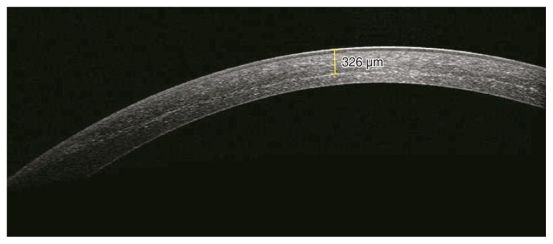 Six-Month Outcomes of Accelerated Corneal Cross-Linking with a Total Dose of 7.2 J/cm2 Using Dextran-Free Riboflavin.