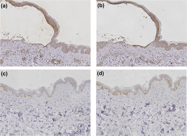 Tofacitinib as a Novel Therapeutic Option for Pemphigus Vulgaris: A Case Report and Mechanistic Insights.