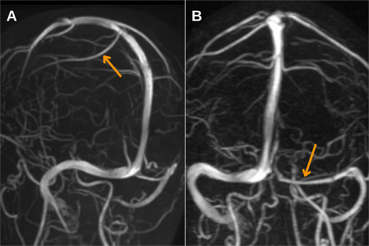 Radiological Findings of Retrograde Venous Cerebral Air Embolism Infarcts: A Case Report and Literature Review.