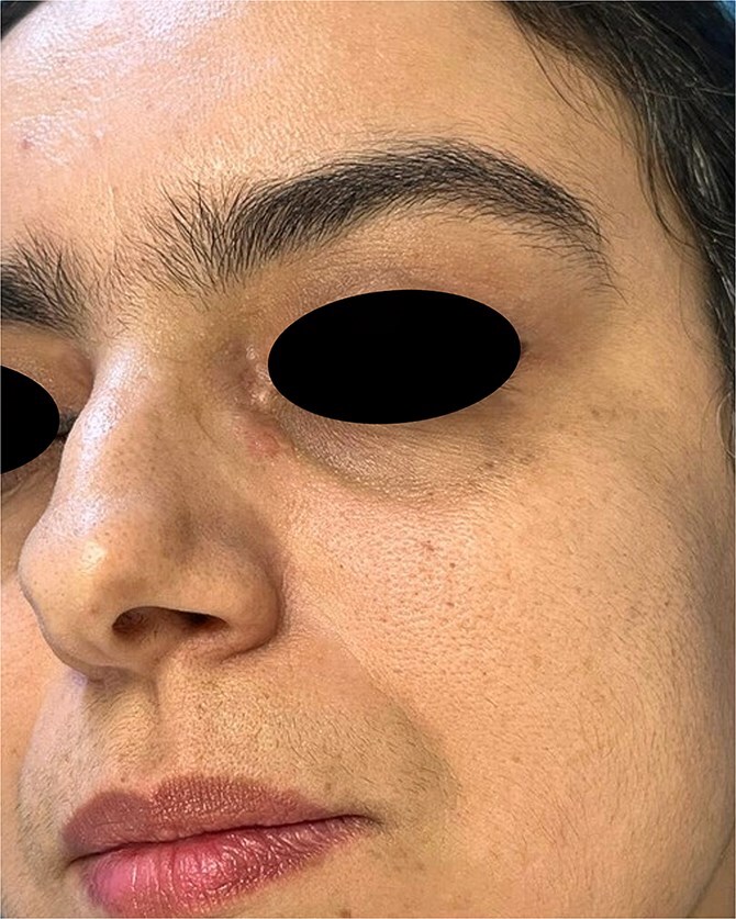 An unusual presentation of cutaneous sarcoidosis induced by Koebner's phenomenon.