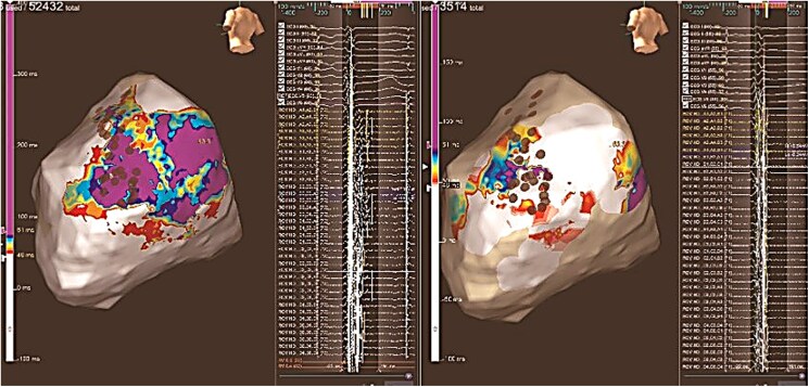 Epicardial ablation of ventricular tachycardia in a patient with dilated cardiomyopathy due to Becker muscular dystrophy: a case report.