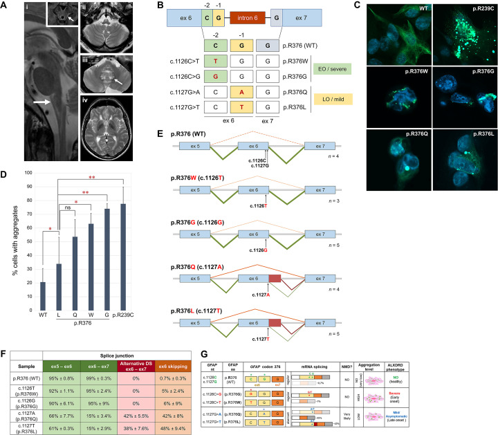 Self-silencing <i>GFAP</i> missense alleles in familial subclinical Alexander disease: implications for therapy.
