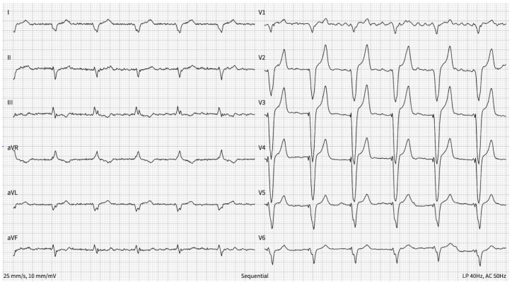 A Case of Success: Guidelines-Based Treatment to Control Atrial Fibrillation-Induced Cardiomyopathy-Atrioventricular Node Ablation and Cardiac Resynchronization Therapy to the Rescue.